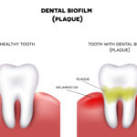 Dental plaque with inflammation and healthy tooth on a white background