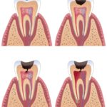 Diagram of tooth with caries stages