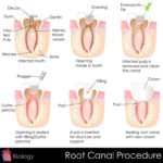 easy to edit vector illustration of root canal procedure of tooth