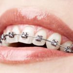 Teeth with braces
