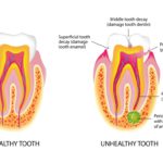 Healthy and unhealthy tooth in cross-section on a white background